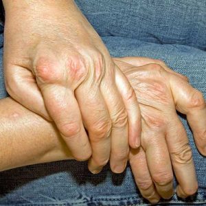 Rheumatologie Wien Rheumatoide Athritis Behandlung-prof.-Fritsch-Stork-Wien-Rheumatologe